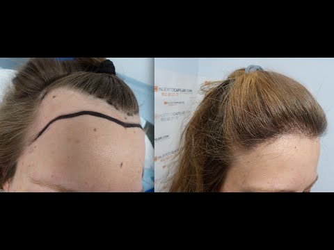 زراعة الشعر للنساء - ابسط الطرق لزراعة الشعر 414 2