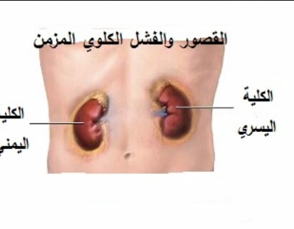 اعراض القصور الكلوي - تعرف على مسببات واعراض 4257 7