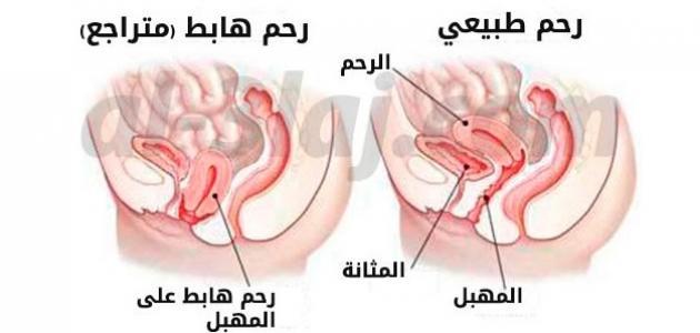 اضرار هبوط المهبل , لابد ان تنتبهى ولا تهملى في هذه الحاله