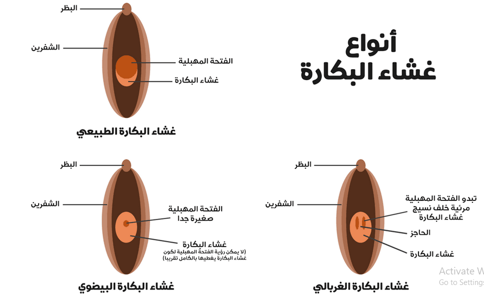 غشاء بكارة ممزق - الفرق بين غشاء سليم وغشاء ممزق 4936