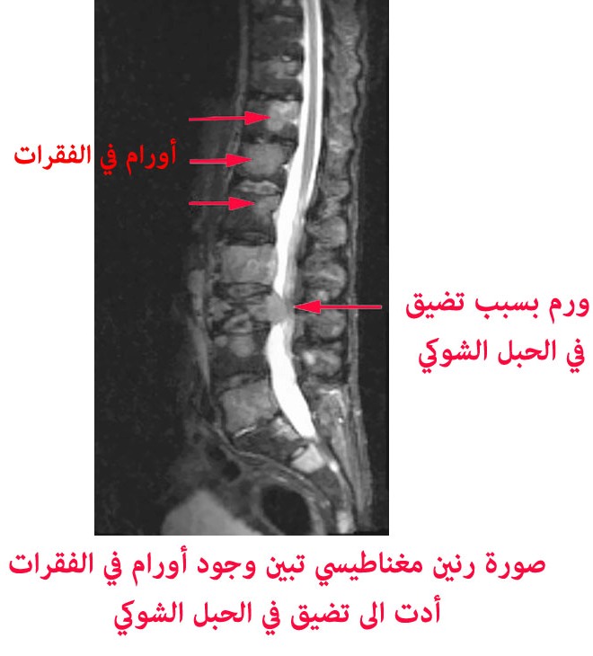 اعراض سرطان النخاع الشوكي , الام ورم النخاع الشوكي