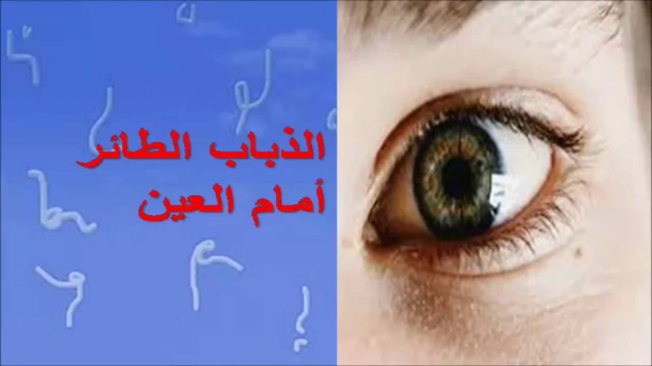 رؤية اشياء سوداء امام العين - انذار شديد الخطورة عن مشكلة بالعين 3634 1