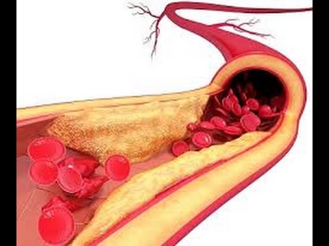 علاج الدهون والكلسترول وتصلب الشرايين خلال اسبوعين , احسن الوصفات التى تعمل على تفتيت الدهون ووخفض مستوى الكوليسترول فى الدم