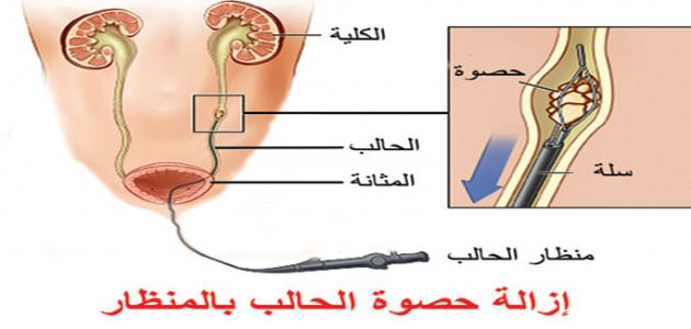 اعراض التهاب الحالب- اسباب وعلاج التهاب الحالب 43517 1