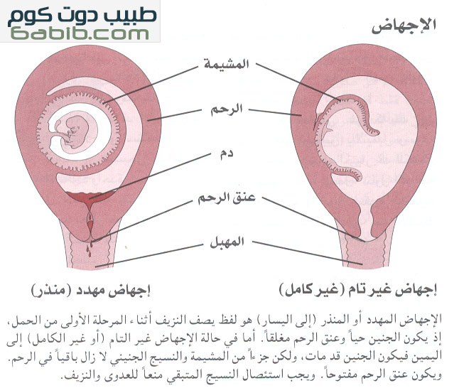 اعراض الاجهاض المبكر - احذري هذه العلامات فانت في مرحلة الاجهاض 668 8