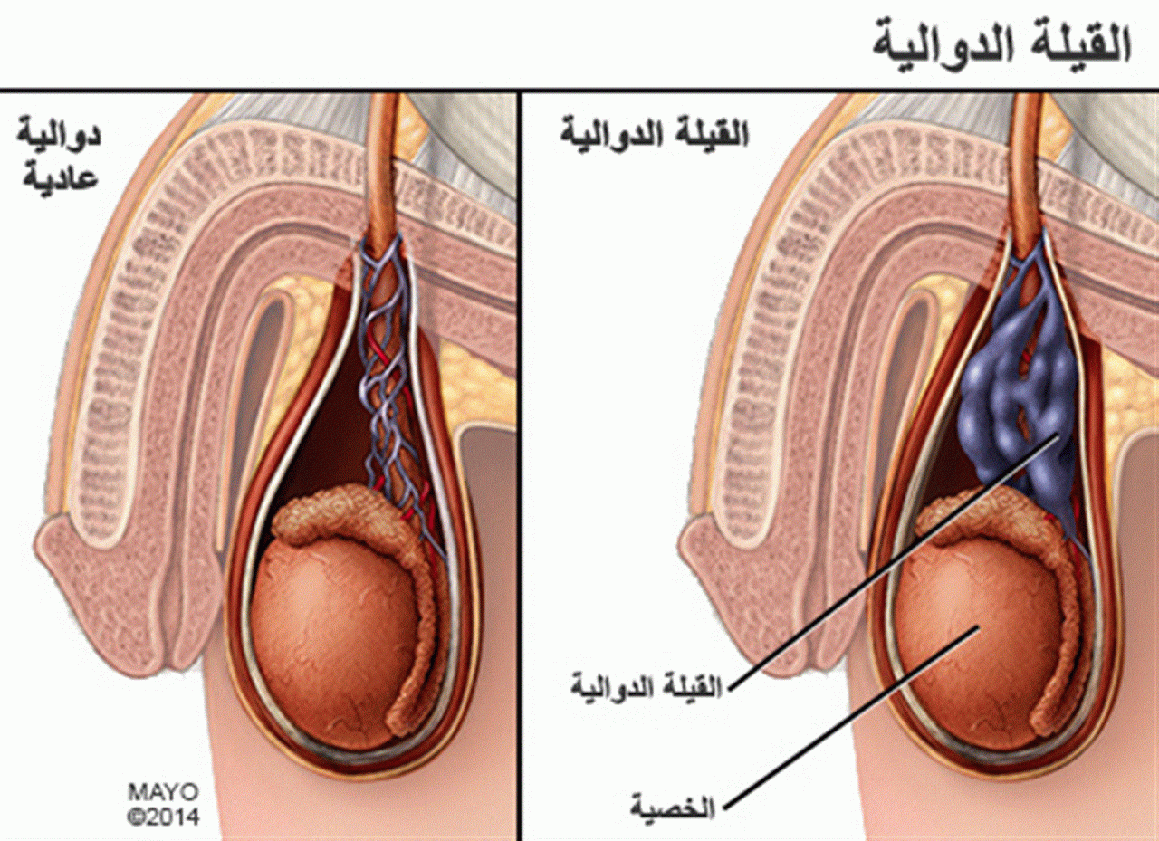 شكل دوالي الخصية بالصور - تعرف على مرض دوالي الخصية للرجال 4463