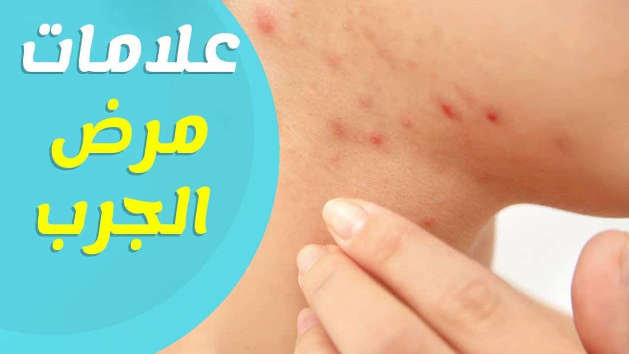 مرض الجرب وعلاجه - ما الاسباب وراء الاصابه بالجرب وكيفيه علاجه 3081 3