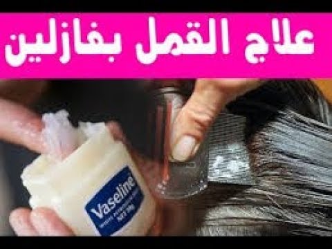 دواء القمل للاطفال - أسباب تواجد القمل للاطفال 4211 4