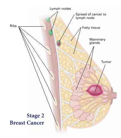 اعراض سرطان الثدي عند الفتيات بالصور - سرطان الثدي و اعراضه 2008 5