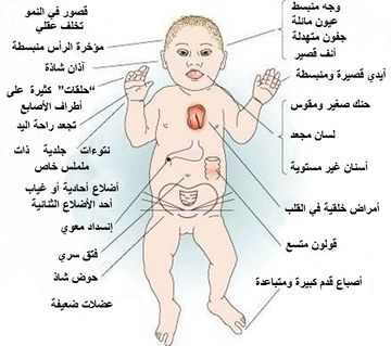 اعراض متلازمة داون - مفهوم متلازمة داون 4089 3