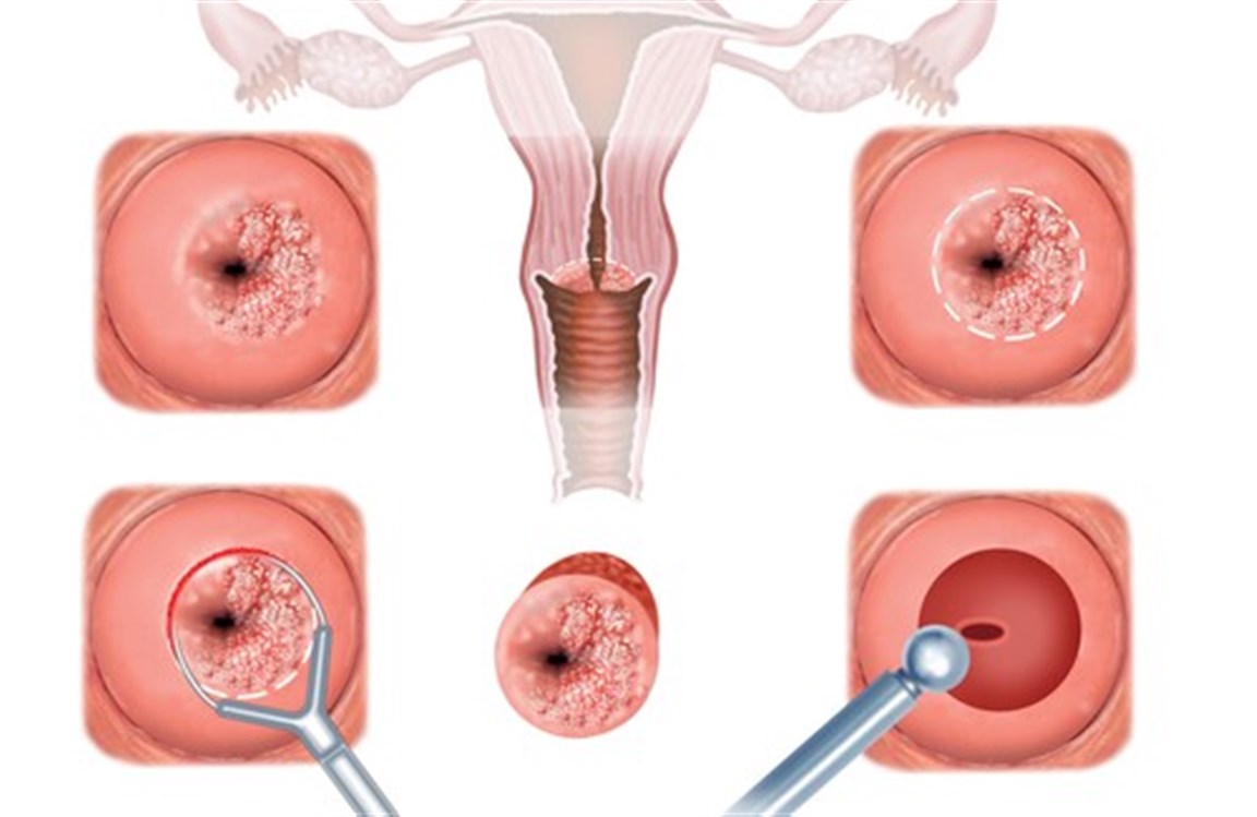 علاج قرحة الرحم بدون كي , علاج طبيبعى لقرح الرحم دول تدخل جراحى او كى
