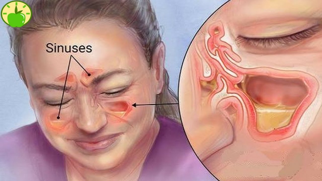 اعراض الجيوب الانفيه بالتفصيل - ما هيا مضاعفات الاصابه بالجيوب الانفيه 2591