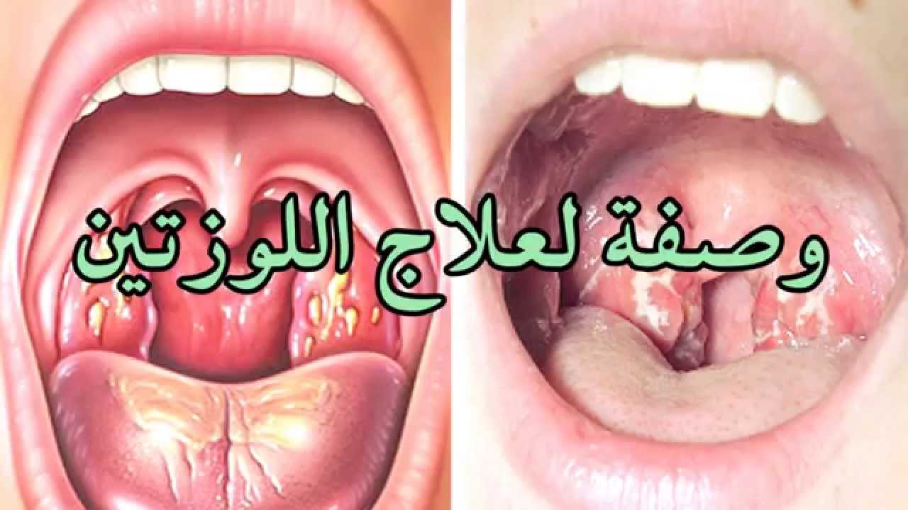 كيفية علاج اللوزتين , اسرع علاج اللوز والاحتقان