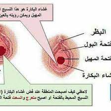 غشاء بكارة ممزق - الفرق بين غشاء سليم وغشاء ممزق 4936 1