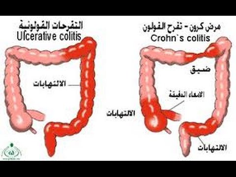 القولون العصبي والدورة الشهرية - العلاج المناسب للقولون العصبى 110 1