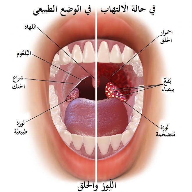 العلاج الطبيعي لالتهاب اللوزتين - طريقة مختلفة تخلصك من التهاب اللوز 3968