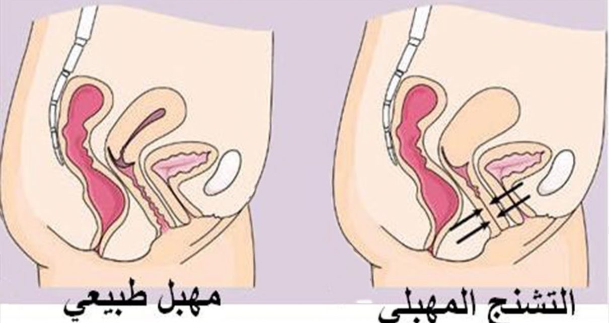 التشنج المهبلي والحمل - ما هو التشنج المهبلى وما ضرره على الحمل 1207