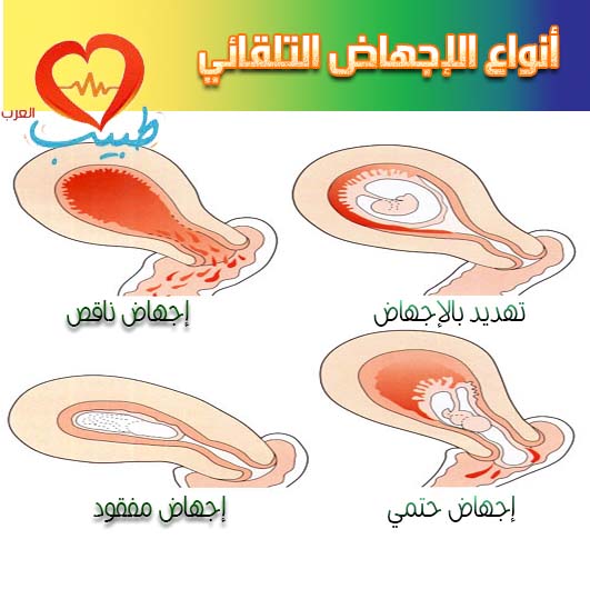 اعراض الاجهاض المبكر - احذري هذه العلامات فانت في مرحلة الاجهاض 668 1