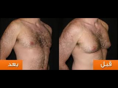 علاج انتفاخ الحلمتين عند الرجال - اسباب انتفاخ الحلمة عند الرجل 444 2