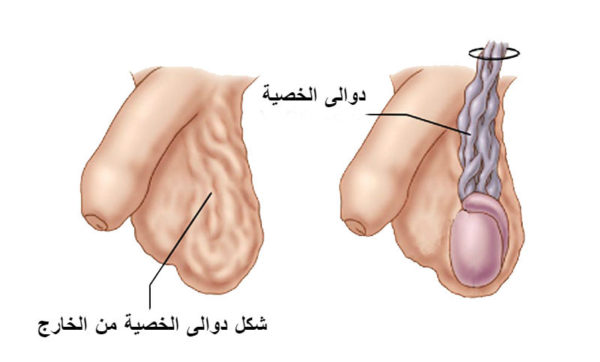 شكل دوالي الخصية بالصور - تعرف على مرض دوالي الخصية للرجال 4463 6