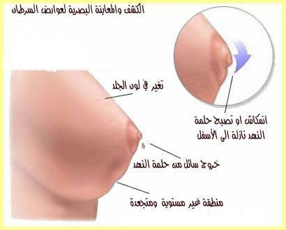 كيس دهني في الثدي - ما هو تشخيص الكيس الدهني الذي يكون موجود في الثدي 2531 1