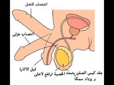 شكل دوالي الخصية بالصور - تعرف على مرض دوالي الخصية للرجال 4463 10