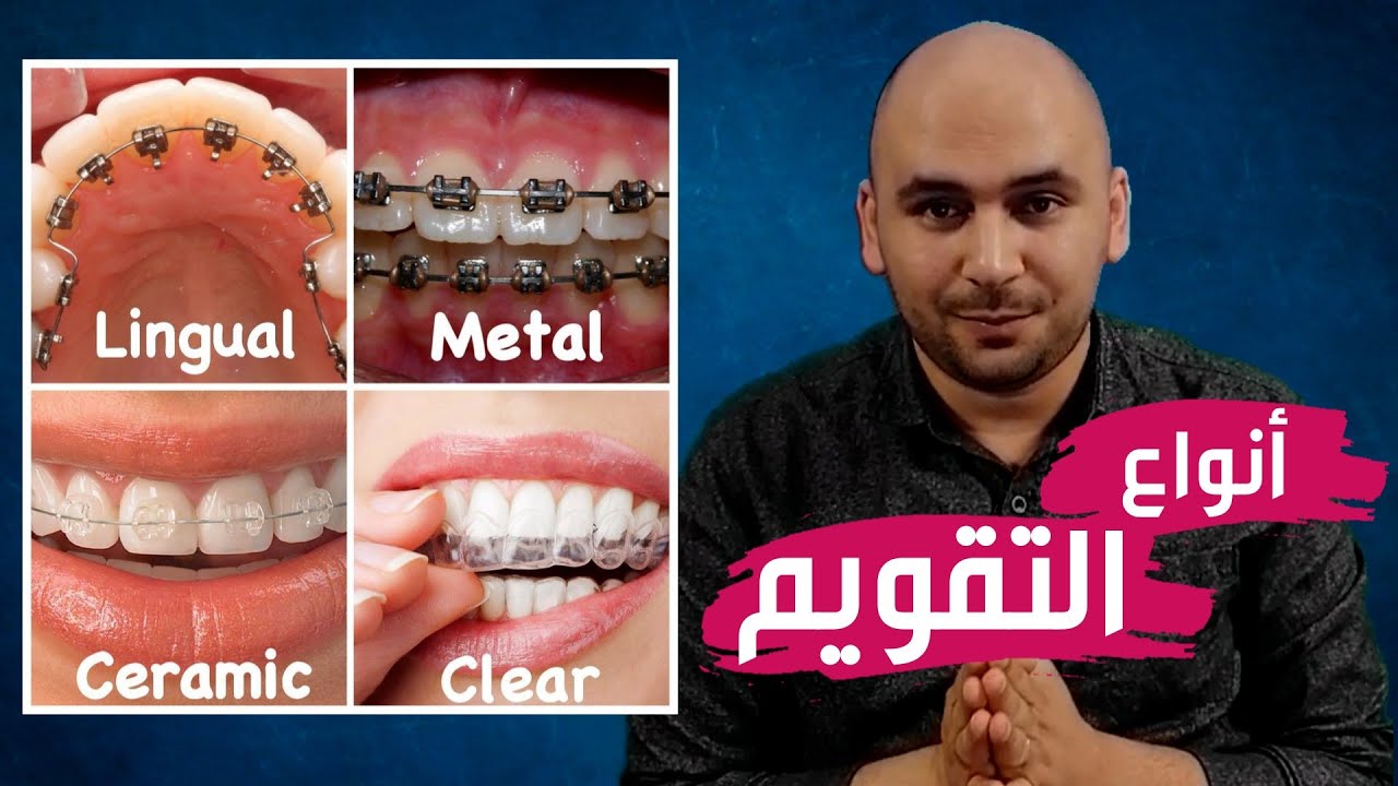 اشكال تقويم الأسنان- معلومات لن تصدقها عن تقويم الاسنان 43322 3