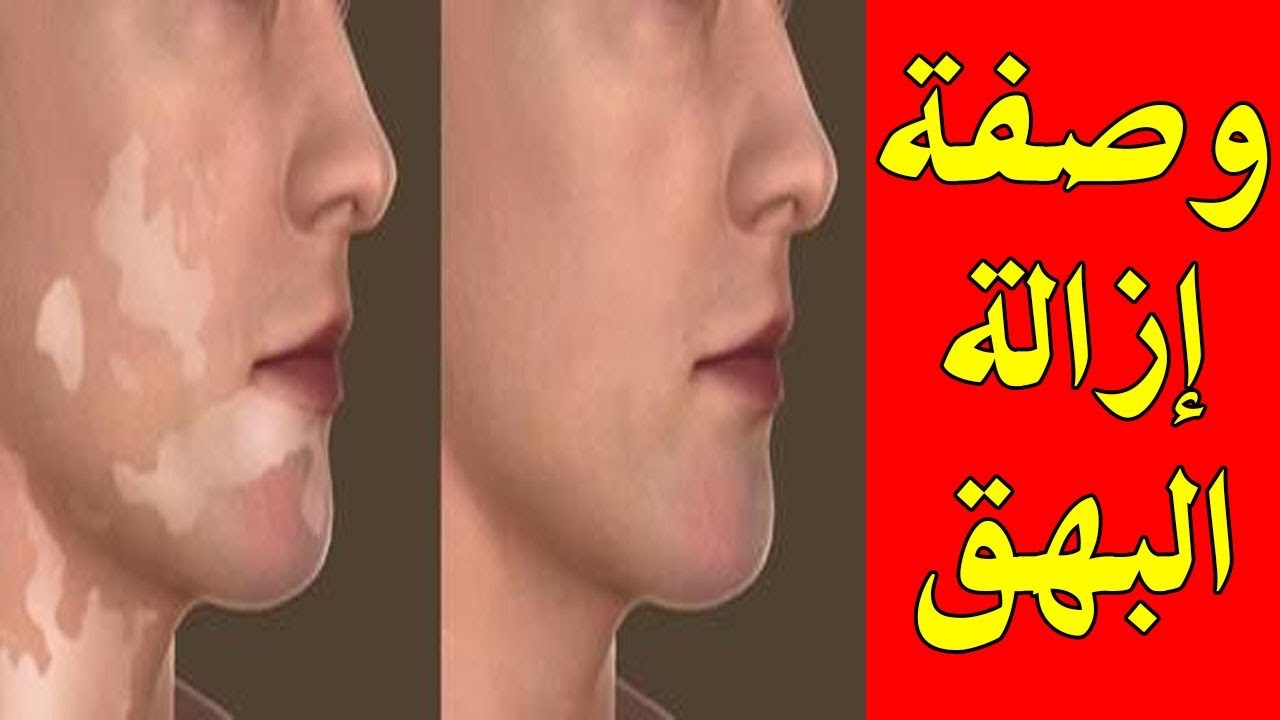 علاج البهاق بزيت الزيتون , انواع العلاج للبهاق بزيت الزيتون