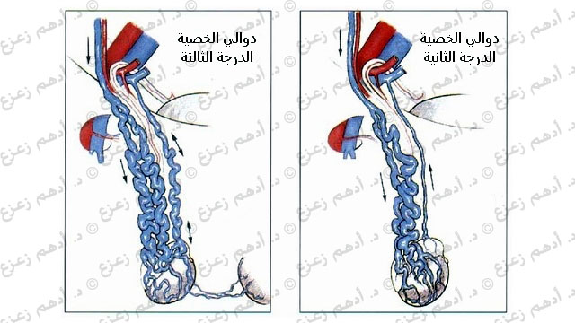 شكل دوالي الخصية بالصور - تعرف على مرض دوالي الخصية للرجال 4463 7