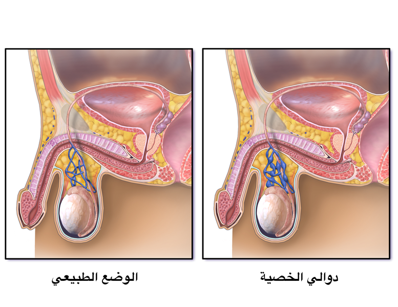 شكل دوالي الخصية بالصور - تعرف على مرض دوالي الخصية للرجال 4463