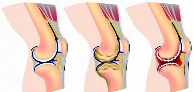 اسباب خشونة المفاصل , تعوية صحية