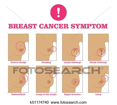 اعراض سرطان الثدي عند الفتيات بالصور - سرطان الثدي و اعراضه 2008