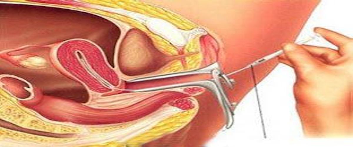 كيف تتم عملية تضييق المهبل , معلومات وطريقة القيام بتضييق المهبل