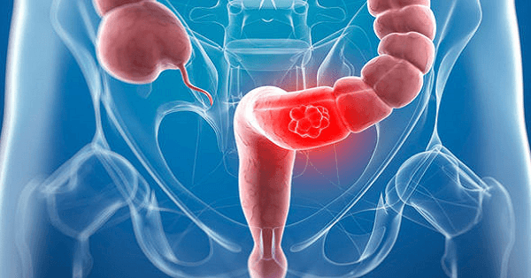 الفرق بين اعراض سرطان القولون والقولون العصبي , لا توهم نفسك واعرف الفرق